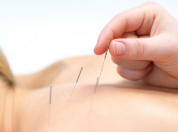 Dry Needling Met Naalden 2